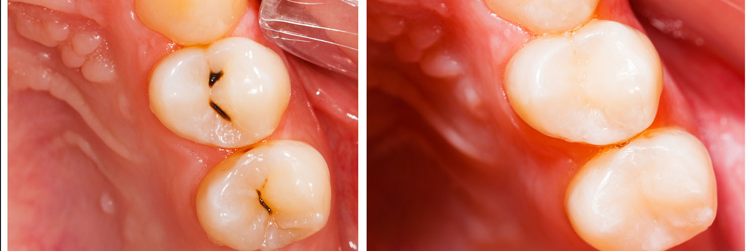 Dr. Aaron Tropmann   Dr. Gary Oyster  | Intraoral Camera, Dental Fillings and Sports Mouthguards